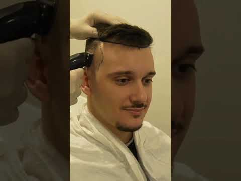 Stevanova priča: povratak samopouzdanja uz transplantaciju kose