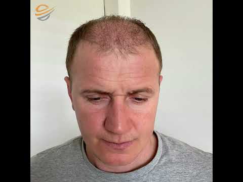 Senijadova promjena života nakon transplantacije kose