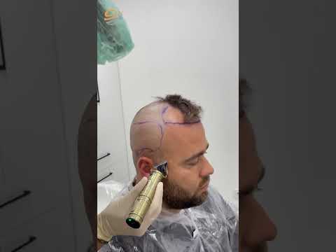 Mesudova uspješna transformacija kose u Turskoj